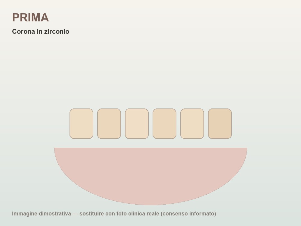 Anteprima caso — Corona singola su molare con frattura