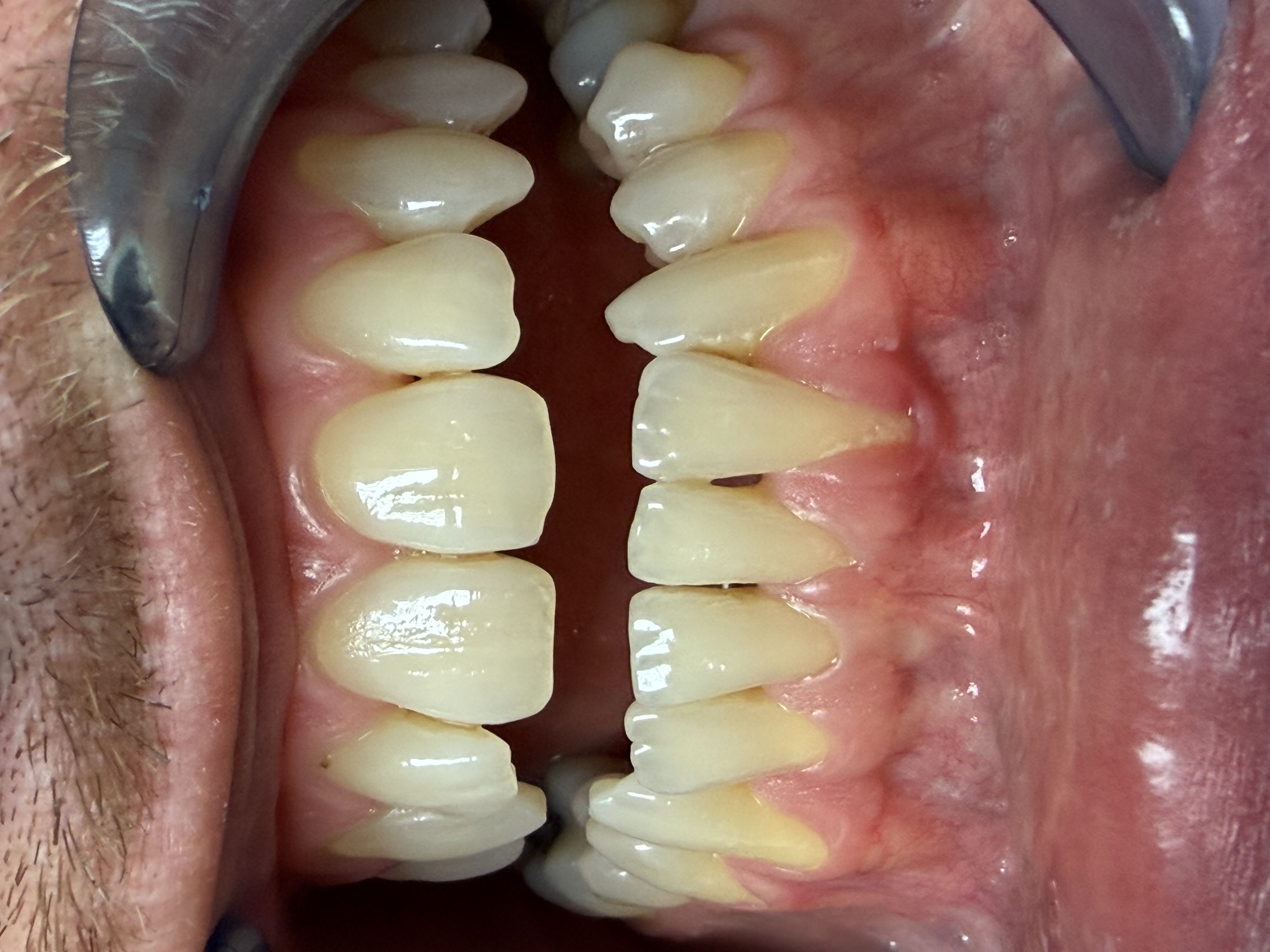 Anteprima caso — Riabilitazione estetica del settore anteriore